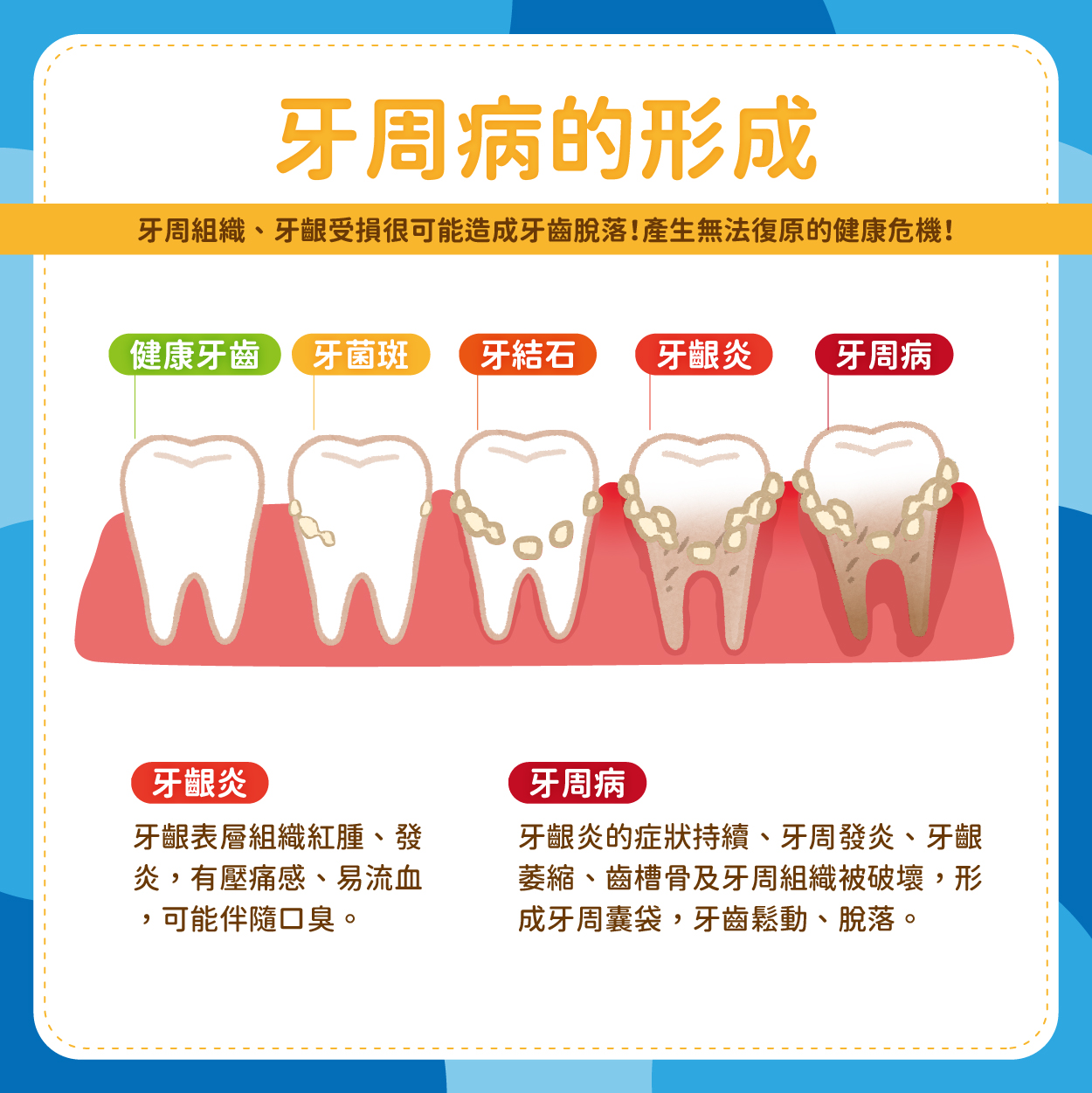 牙周組織、牙齦受損很可能造成牙齒脫落，進而造成牙齦炎、牙周病等健康危機！