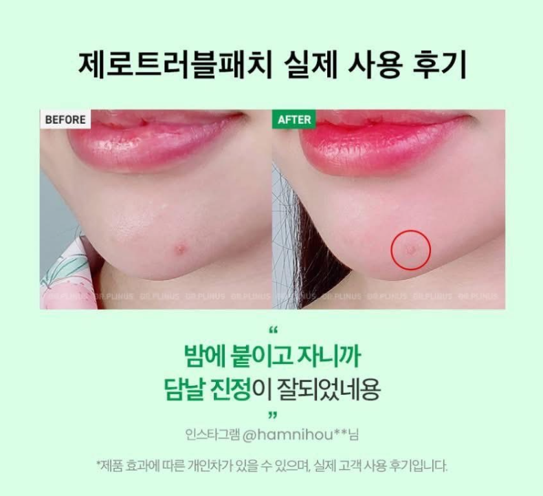 韓國Dr.Plinus 微針痘痘貼 27 片（9×3 小包）,U60550008,韓國Dr.Plinus微針痘痘貼27片（9×3小包）,修護肌膚,舒緩紅腫,所有商品